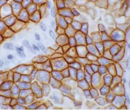HER2 immunohistochemistry photomicrograph